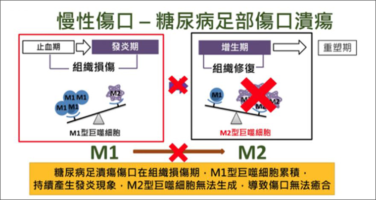 慢性傷口糖尿病足部潰瘍，因M1型巨噬細胞累積，M2型巨噬細胞無法生成，導致傷口無法癒合